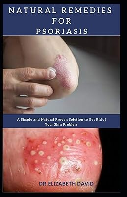Natural remedies against psoriasis: a simple and natural solution proven to get rid of your skin problem: dermatitis, eczema, psoriasis, rosacea and more.. DIAYTAR NIGERIA: Bringing quality products to your doorstep at prices that won't break the bank.